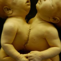Conjoined twins mummified