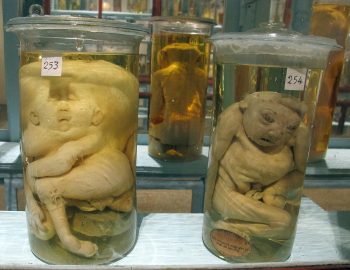 <b>Author:</b> sailko<br>
<b>License:</b> <a href="https://creativecommons.org/licenses/by-sa/3.0/" target="_blank" rel="noopener">CC BY-SA 3.0</a> Istituto di anatomia patologica museo campioni 05 feti malformati Wikimedia sailko CC BY SA 3 0